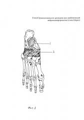 Способ функционального артродеза при диабетической нейроостеоартропатии (стопа шарко) (патент 2604383)