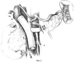 Способ панкреатодуоденальной резекции при местнораспространенном раке периампулярной области с обширной опухолевой инвазией магистральных вен мезентерико-портальной системы (патент 2336831)