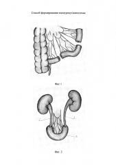 Способ формирования илеоурокутанеостомы (патент 2655950)
