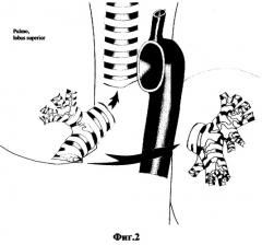 Способ реконструкции бифуркации трахеи после циркулярной резекции карины и левого главного бронха (патент 2270616)