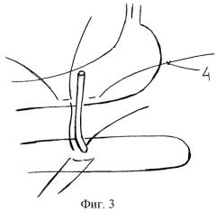 Способ интраоперационного дренирования панкреатического протока при раке поджелудочной железы (патент 2290088)