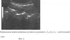 Способ диагностики патологии межпозвонковых суставов поясничного отдела позвоночника (патент 2299014)