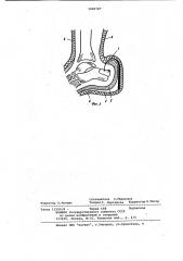 Способ закрытой репозиции перелома пяточной кости (патент 1069787)