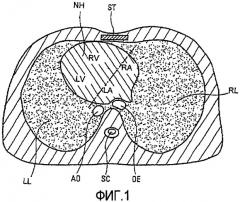 Цельный сердечный протез, имплантируемый в анатомической позиции (патент 2409394)