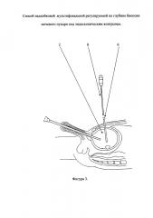 Способ надлобковой мультифокальной регулируемой по глубине биопсии мочевого пузыря под эндоскопическим контролем (патент 2641838)