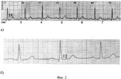 Способ диагностики внутрипредсердной блокады i степени у лиц молодого возраста с тахикардией (патент 2485882)