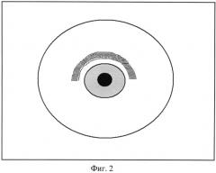 Способ дозированного снижения внутриглазного давления при глаукоме (патент 2572021)
