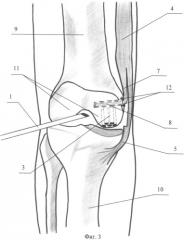 Способ аутопластики суставных поверхностей при деструктивно-дистрофических заболеваниях коленного сустава (патент 2484784)