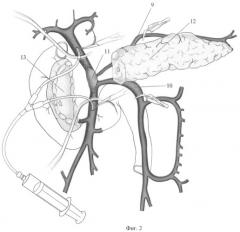 Способ хирургического лечения хронического панкреатита, осложненного портальной гипертензией (патент 2452406)