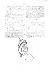 Устройство для вспомогательного сокращения миокарда (патент 1572646)