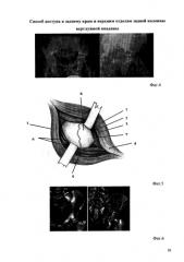 Способ доступа к заднему краю и верхним отделам задней колонны вертлужной впадины (патент 2585748)