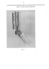 Способ замещения выраженных дефектов костей, формирующих локтевой сустав, при его тотальном эндопротезировании (патент 2662899)