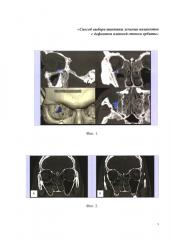Способ выбора тактики лечения пациентов с дефектом нижней стенки орбиты (патент 2661004)