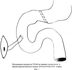 Способ хирургического лечения наружного свища двенадцатиперстной кишки (патент 2352268)