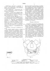 Устройство для репозиции отломков нижней челюсти (патент 1598994)