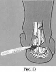 Способ хирургического лечения плоско-вальгусной деформации стоп у детей с врожденным вертикальным тараном (патент 2405491)