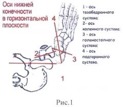 Способ хирургической коррекции проксимального отдела бедренной кости при дисплазии тазобедренных суставов (патент 2492828)