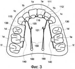 Ортодонтическая проволочная лигатура для исправления бимаксиллярной протрузии и ортодонтическая система с этой проволочной лигатурой (патент 2569715)