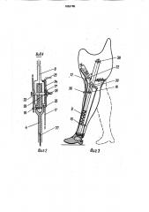 Парный протез нижних конечностей (патент 1653765)