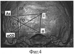 Способ краниотомии при опухолях мостомозжечкового угла (патент 2540165)