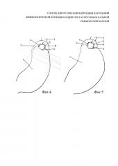 Способ хирургической коррекции нарушений физиологической функции кардии при гастроэзофагеальной рефлюксной болезни (патент 2641064)