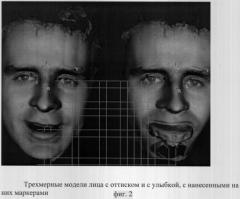 Способ построения трехмерного изображения лица и зубных рядов, сопоставленных в корректном друг относительно друга положении (патент 2306113)