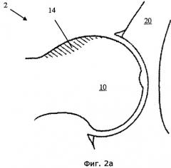 Устройство и способ для лечения бедренно-вертлужного соударения (патент 2506928)