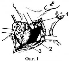 Способ шейной эзофагостомии (патент 2272581)