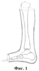 Способ лечения переломовывихов в голеностопном суставе с инверсионным подвывихом таранной кости (патент 2415651)