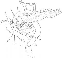 Способ хирургического лечения наружных панкреатических свищей (патент 2447839)