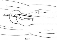 Способ реинсерции сухожильно-мышечного обшлага вертельной области бедра при эндопротезировании тазобедренного сустава (патент 2381011)