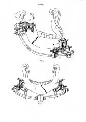 Устройство для остеосинтеза переломов нижней челюсти (патент 1149954)