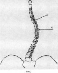 Способ коррекции идиопатического сколиоза позвоночника грудопоясничной локализации у детей (патент 2562511)