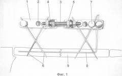 Способ и устройство для лечения диафизарных переломов ключицы (патент 2373887)