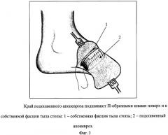 Способ формирования культи стопы (патент 2308244)