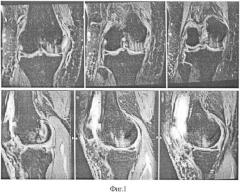 Способ восстановления дефектов гиалинового хряща суставных поверхностей суставов конечностей (патент 2559089)