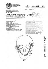 Устройство для лечения переломов верхней челюсти (патент 1482685)