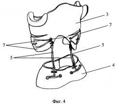 Активный элемент ортопедических устройств (варианты) (патент 2295322)