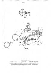Хирургическое устройство (патент 1454416)