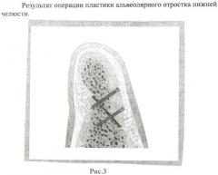 Способ пластики альвеолярного отростка нижней челюсти при его атрофии (патент 2414181)