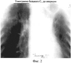 Способ хирургического лечения туберкулеза легких (патент 2246263)