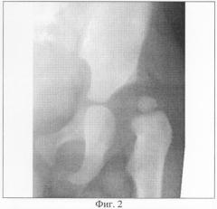 Способ лечения врожденной дисплазии вертлужной впадины (патент 2311884)