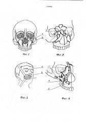 Способ лечения переломов костей средней зоны лицевого черепа (патент 1797869)