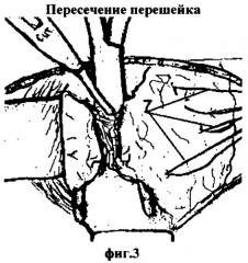 Способ экстрафасциального удаления доли щитовидной железы (патент 2357684)