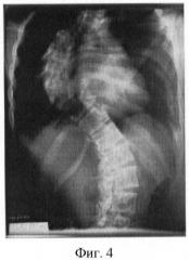 Способ лечения идиопатического сколиоза (патент 2434599)