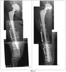 Способ удлинения бедра с установленным эндопротезом (патент 2547780)