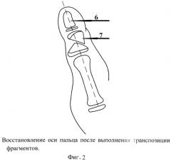 Способ оперативного лечения клинодактилии первого пальца кисти при акроцефалосиндактилии (патент 2546503)