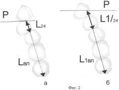 Способ биометрической диагностики направления и величины перемещения зубов при ортодонтическом лечении (патент 2436538)