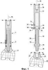 Протез для частичной замены трубчатой кости (патент 2532891)
