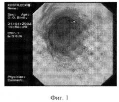 Способ дифференциальной диагностики степени рефлюкс-эзофагита (патент 2257149)